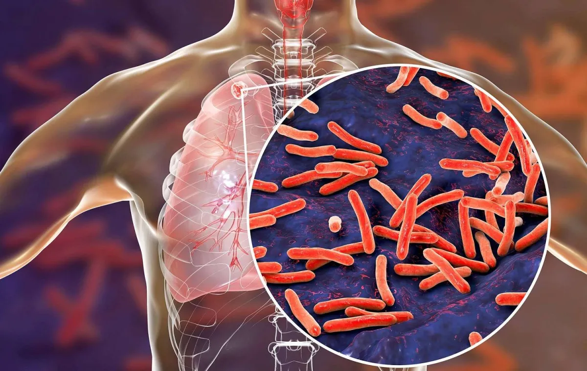 طريقة مبتكرة لعلاج مرض السل